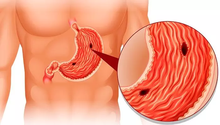Язва на теле желудка