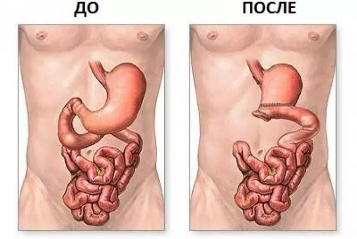 Схема резекции желудка