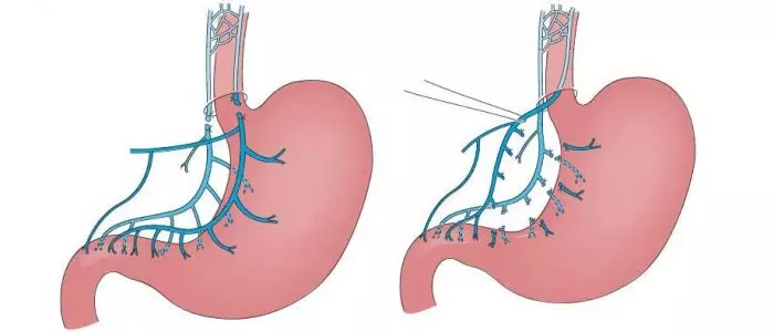Схема ваготомии желудка