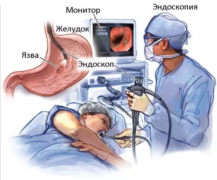 Эндоскопические операции на желудке