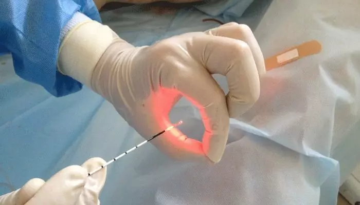 Подготовка к лазерному удалению новообразования Подготовка к лазерному удалению новообразования